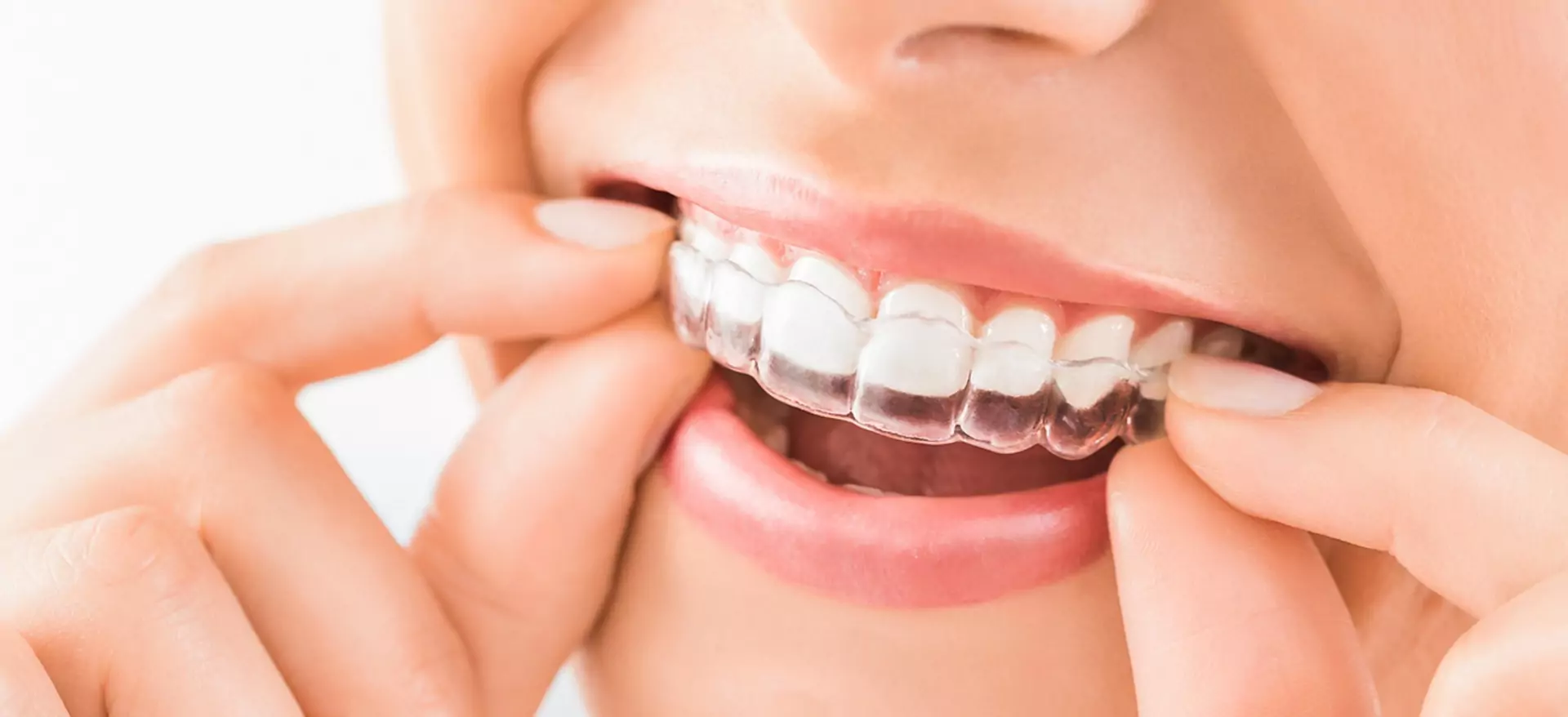 invisalign (1)